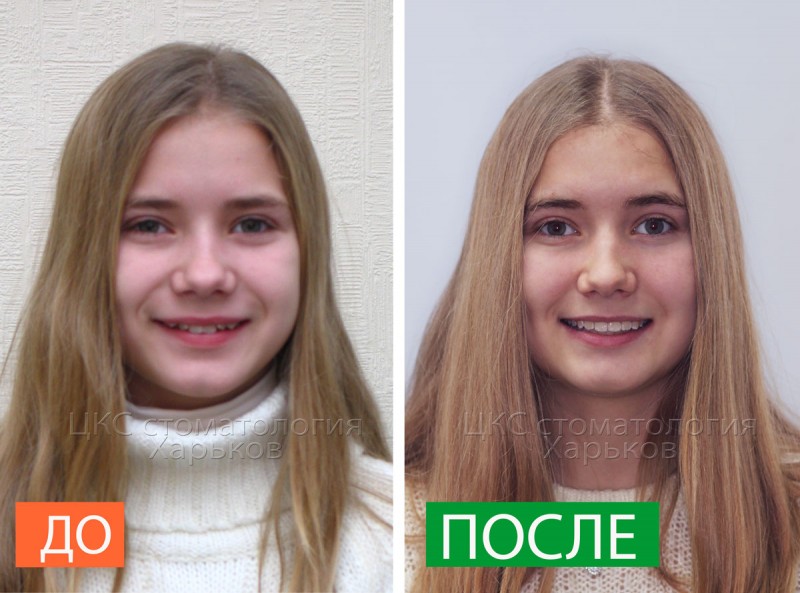 улыбка-до-и-после-лечения-брекетами