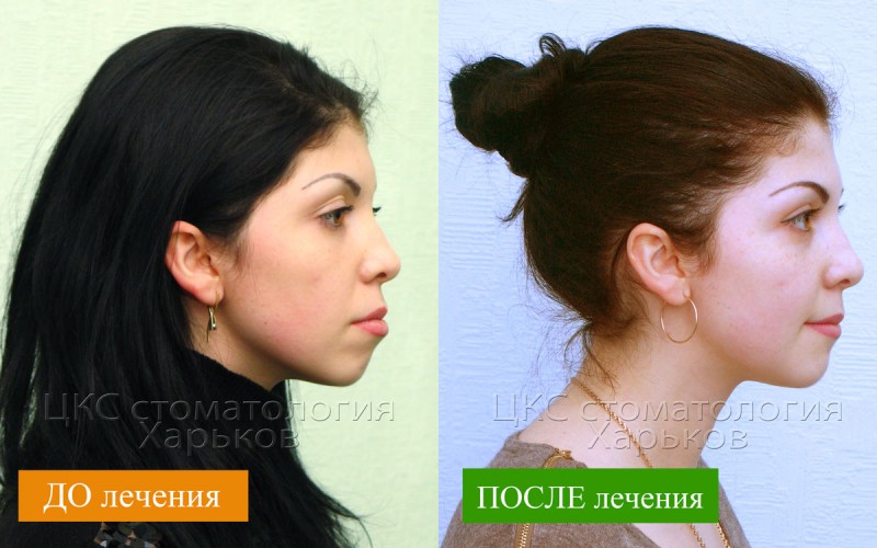 ДО-и-ПОСЛЕ-лечения-брекетами-Харьков
