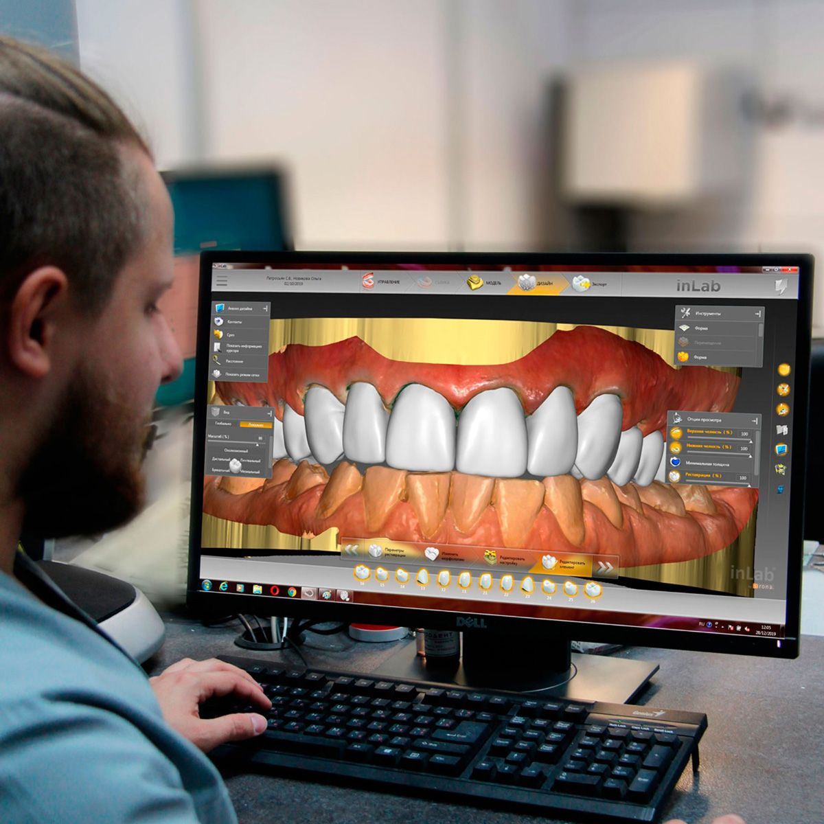Зуботехнические работы в цифровом протколе Sirona