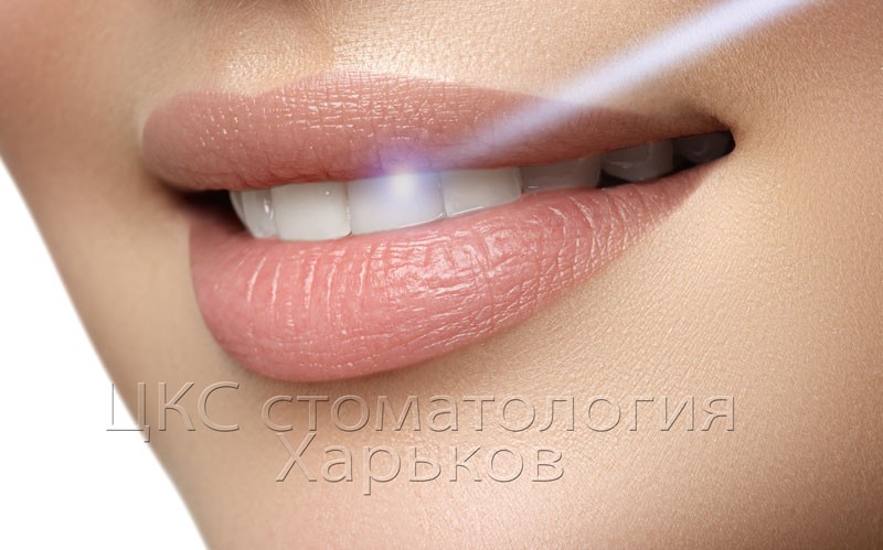 красивые-керамические-виниры-в-харькове