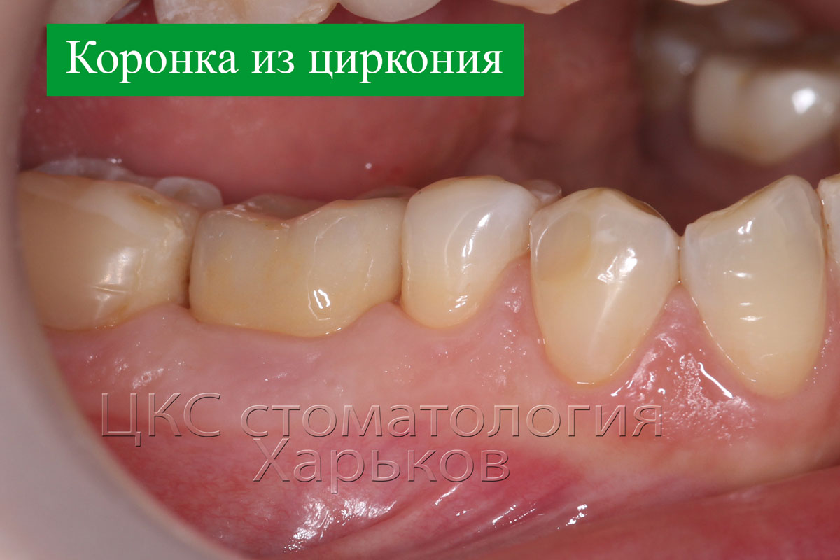 в финале изготовлена коронка из диоксид циркония