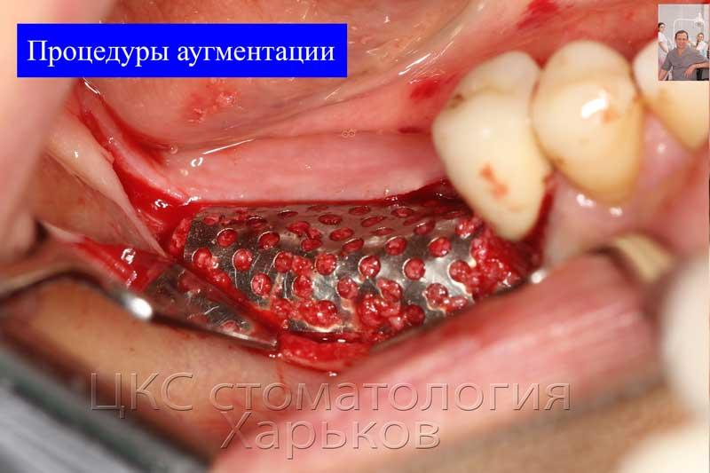 использование костного графта для проведении аугментации