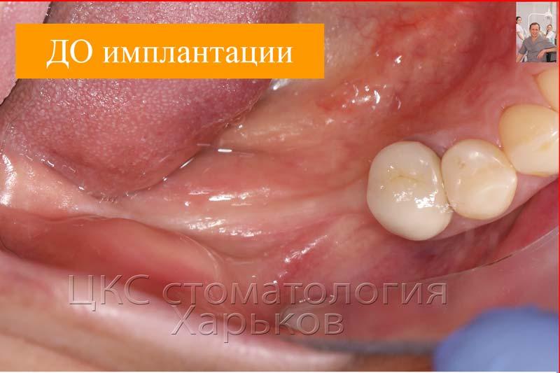 узкий альвеолярный гребень