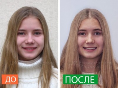 Брекеты. Легко ли сделать свою улыбку?