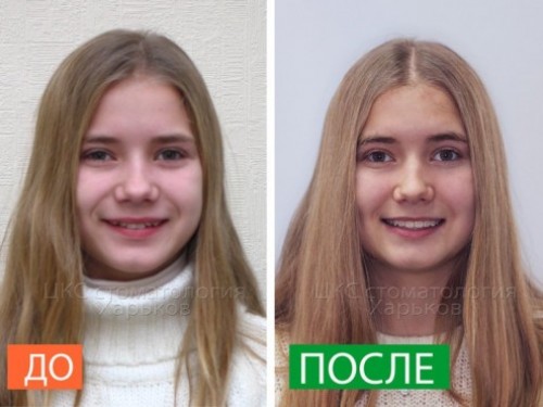 Брекеты. Легко ли сделать свою улыбку?